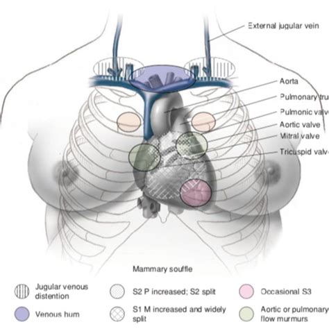 Gagal jantung kronik perlu dibedakan dari gagal jantung akut dimana gagal jantung kronik merujuk kepada kegagalan jantung yang secara relatif lebih stabil tetapi dengan kondisi simptomatik, dalam beberapa kasus dipertimbangkan sebagai compensated heart failure. (PDF) Diagnosis Penyakit Jantung Dalam Kehamilan