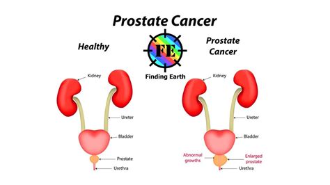Prostate Cancer Symptom Causes And Diagnosis Youtube