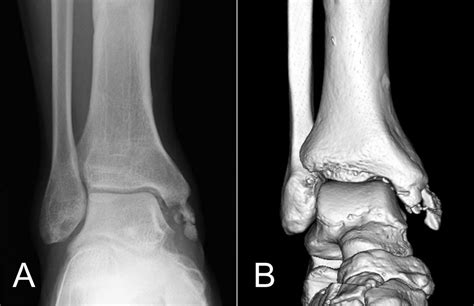 Medial Malleolus Ankle Fracture The Radiology Assistant Ankle