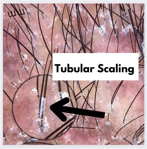 Tubular Scaling In Lichen Planopilaris Lpp — Donovan Hair Clinic