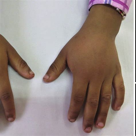 The Clinical Image Showing The Left Hand With Swelling Over The Dorsal