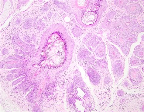 Pathology Outlines Trichofolliculoma