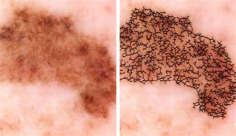 Can you lower your risk of the melanoma progressing or coming you should have your doctor check any suspicious skin markings and any changes in the way your. Researchers develop automated melanoma detector for skin ...