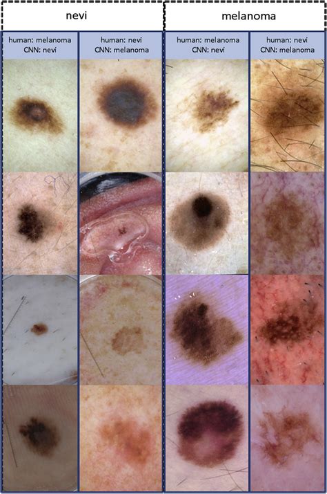 Deep Neural Networks Are Superior To Dermatologists In Melanoma Image