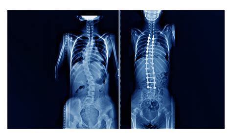 Scoliosis In Adults Proliance Orthopedic