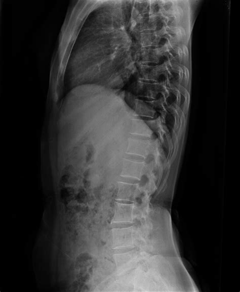 Spina Bifida Radrounds Radiology Network