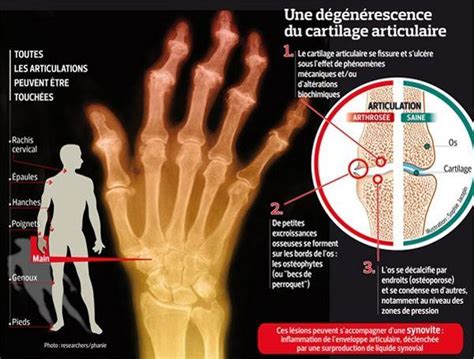 En plus de la gêne fonctionnelle, l'arthrose provoque également une importante douleur au pouce. Douleur de la main - Arthrose de la main - Fiches santé et ...