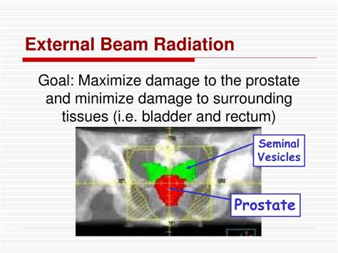 Ppt Carcinoma Of The Prostate Powerpoint Presentation Free Download