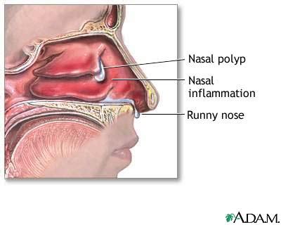 Nasal Polyps MedlinePlus Medical Encyclopedia Image