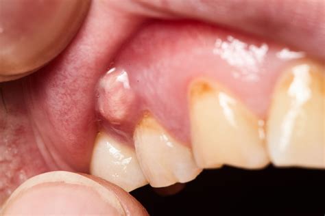 Gum Boils Symptoms Causes Home Remedies And Treatments