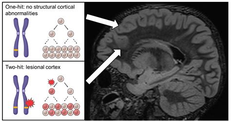 Ijms Free Full Text Cortical Dysplasia And The Mtor Pathway How