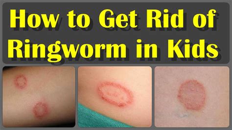 How To Get Rid Of Ringworm Infection In Kids Remedies For Ringworm