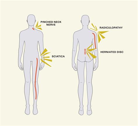 What Is A Pinched Nerve Common Causes And Treatments