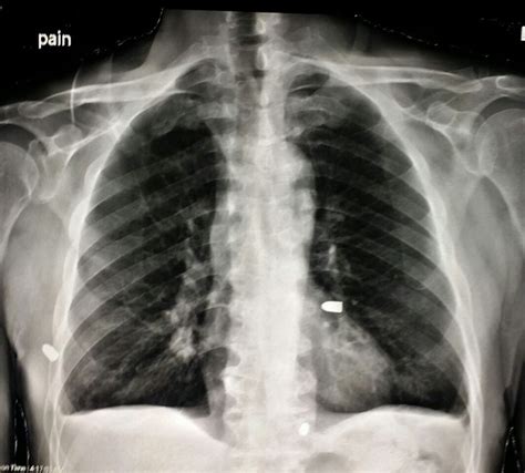 Describe a general approach to gun shot wounds (or gsw) in the trauma bay or emergency department. 1000+ images about X-rays on Pinterest