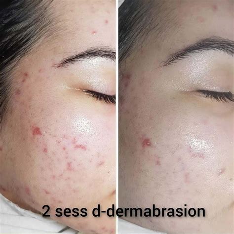 Dermabrasion Everything You Need To Know About The Treatment