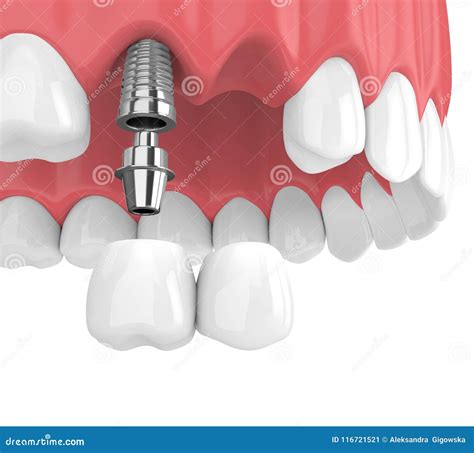 3d Render Of Jaw With Implants Supported Dental Bridge Royalty Free