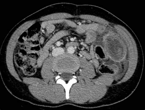 Rupture Of An Echinococcal Cyst Within The Colon In A Case Of