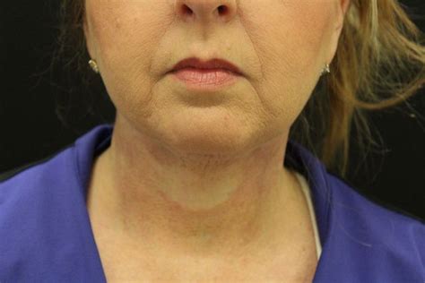 Case 21 Face And Neck Lifts Before And After Gallery