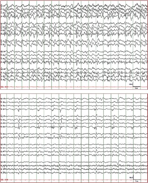 Eeg Of Patient 4 Top 1 To 2s Lateralized Left Right Periodic