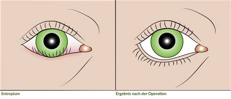 Mit der richtigen einnahme und dosierung. Lidchirurgie | Augentagesklinik Sindelfingen
