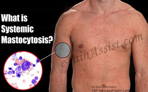 Systemic Mastocytosistypes Causes Symptoms Diagnosis Treatment My XXX