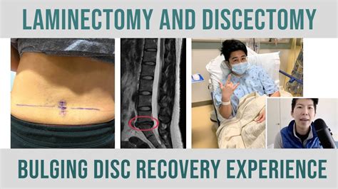 Laminectomy And Discectomy Surgery Experience From A Bulging Disc To Recovery And Walking Again