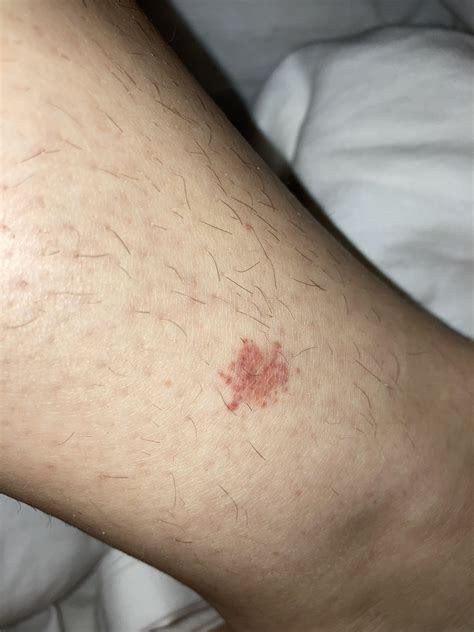Red Spot On Leg Pictures Photos