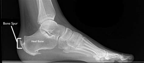 Bone Spurs Usually In A Joint Can Be Especially Painful When On The