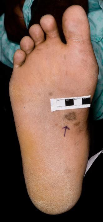 Plantar Lesions Right Foot Figure 4 Truncal Rash Detail Download