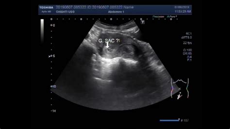 Ultrasound Video Showing Detection Of Early Pregnancy With Decidual