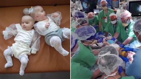 Conjoined Twin Babies Fused At Head Successfully Separated After 24