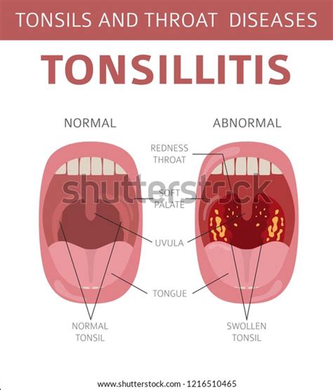 Tonsils Throat Diseases Tonsillitis Symptoms Treatment Stock Vector