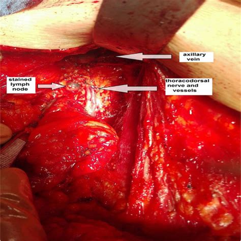 Example Of Axillary Lymph Node Dissection For This Patient The Total
