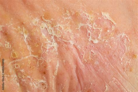 Severe Pustular Psoriasis Lesions On The Sole Of The Foot 스톡 사진 Adobe