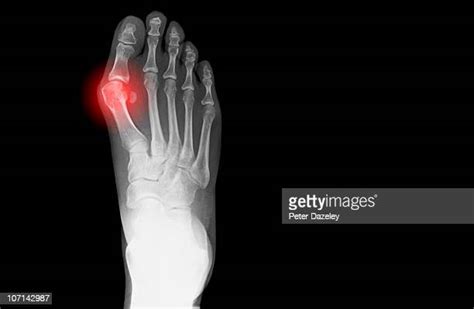 Toe Deformity Photos And Premium High Res Pictures Getty Images