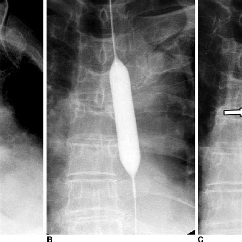 Pdf Benign Strictures Of The Esophagus And Gastric Outlet