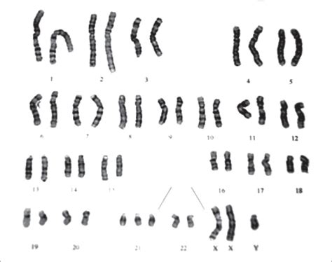 Karyotype Of The Infant With 48xxy21 The Arrows Indicate The Extra