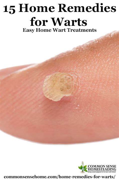 15 Home Remedies For Warts Easy Home Wart Treatments Total Survival