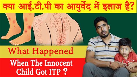 Does Itp Have Treatment In Ayurveda Idiopathic Thrombocytopenic