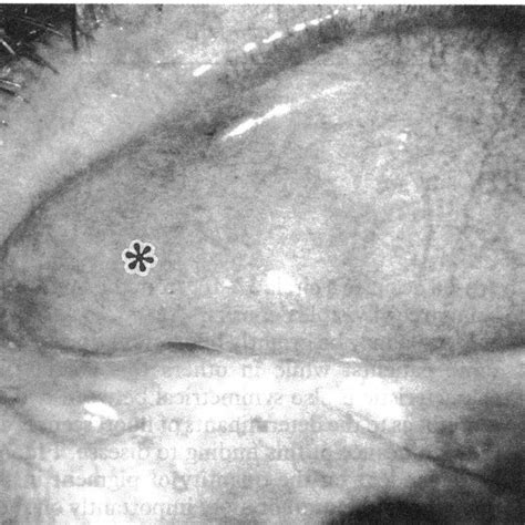 Case 2 An Elevated Amelanotic Anaplastic Malignant Melanoma 4 X 5 Mm