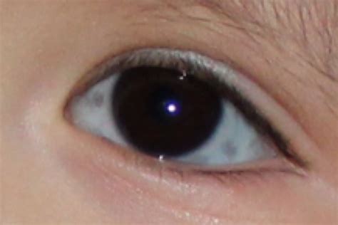 Grey Spots On White Of Eye Babycenter