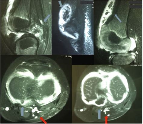 A 2 Year Old Child With Worsening Knee Pain Jbjs Image Quiz