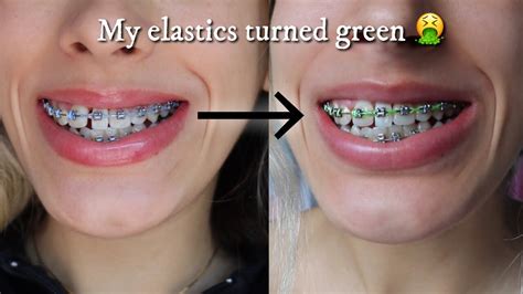 Clear Braces With Purple Bands