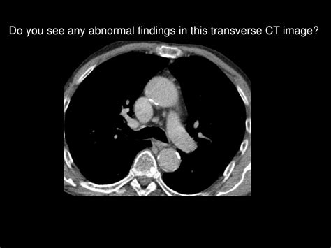 Ppt Image Gallery Lesion Detection On Low Dose Chest Ct Powerpoint