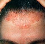 Psoriasis Hairline Home Remedies Images