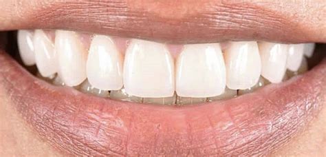 There are many dental materials example: Transform Your Smile with Dental Veneers - Grady Dental ...