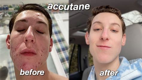My Accutane Journey Six Month Skin Transformation Youtube
