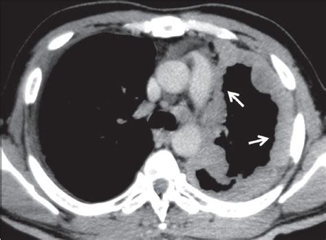 Malignant Mesothelioma Of Lung Mesothelioma Symptoms Causes Types