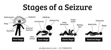 Seizures Symptoms Causes And Treatment Santripty