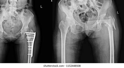 Gluteal Tuberosity Femur Fracture Post Surgical